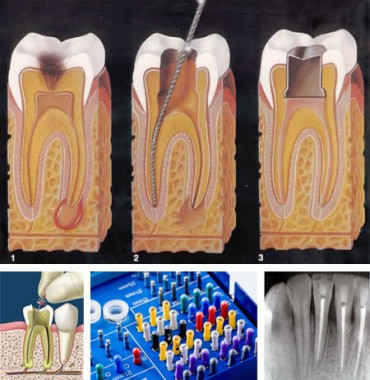 endodoncia