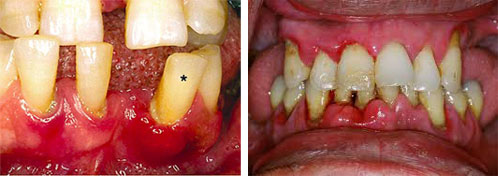 periodontitis